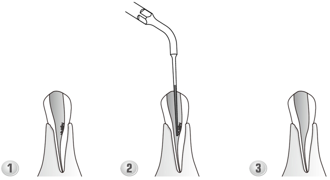 Сфера применения наконечника для скалера